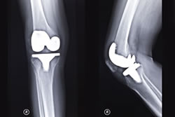 Photo of a knee x-ray.