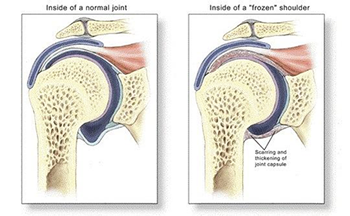 Frozen shoulder