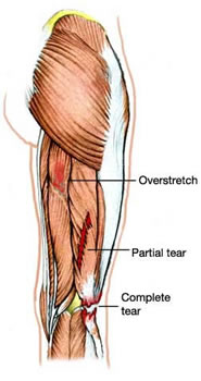 Classes of hamstring strains