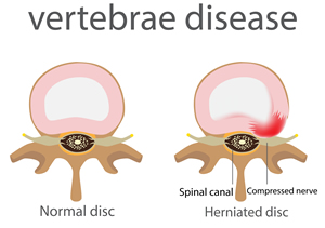 Vertebrae disease