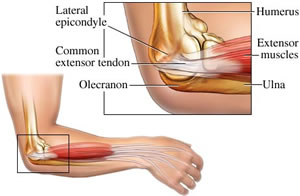 Lateral Epicondylitis