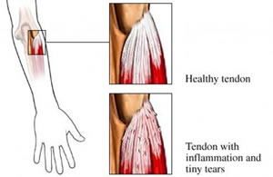 Lateral Epicondylitis