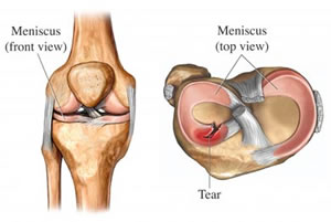 Superior view meniscal tear