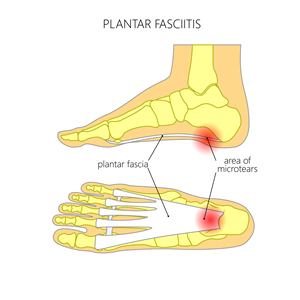 Plantar fascia