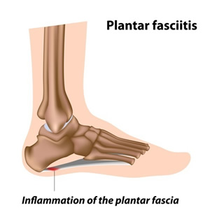 Plantar fascia